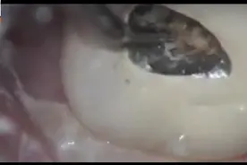 牙齿里面破了个洞，竟然有那么多的垃圾在里面，难怪会口臭视频封面