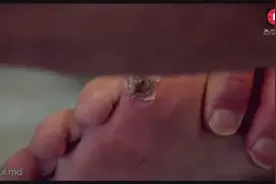 高温天看一看液氮冷冻治疗脚上的巨大寻常疣（瘊子）视频封面