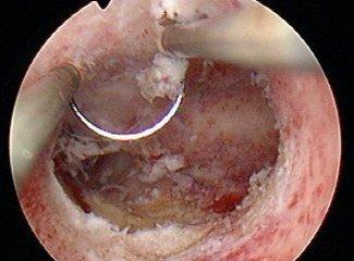盘点宫腔粘连的六大治疗方法,哪个最靠谱?