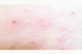 神经性皮炎的病因是什么？