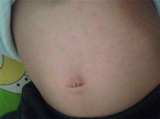 怀孕肚子长小红点不痒