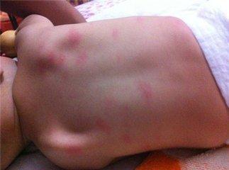 怀孕肚子长小红点不痒