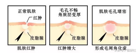 大腿鸡皮疙瘩激光
