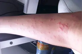 得了丘疹性荨麻疹，会不会传染给他人呢？需要注意什么呢？视频封面