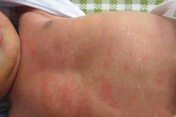 怀孕肚子长小红点不痒