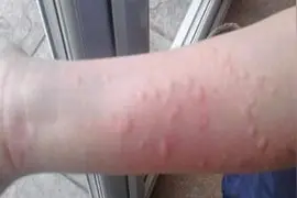 吃这些食物治疗荨麻疹效果奇特，果断分享视频封面