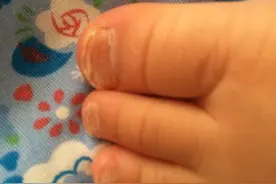孩子脚趾甲生长不好凹陷什么原因？图片