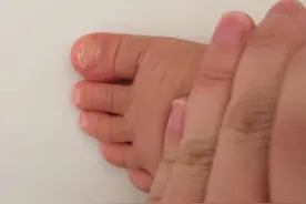 孩子脚趾甲扁平分层是缺什么?图片