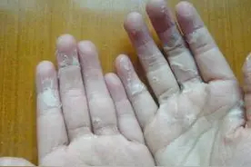 手脚脱皮到底是怎么一回事？图片