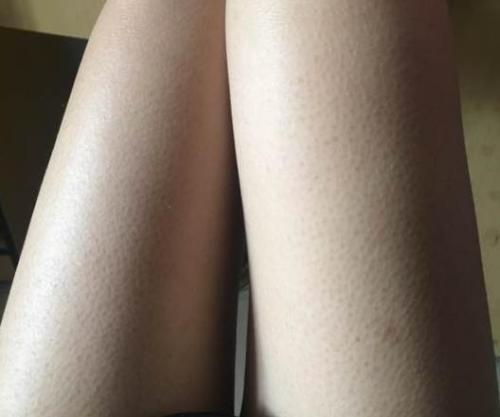 宝宝皮肤一块鸡皮颗粒