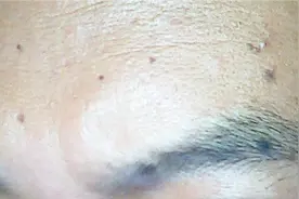 脸上为什么会长黑斑？长黑斑和哪些因素有关