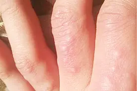 手指上就长满了颗粒状的小水泡，其实这不是常见的湿疹视频封面