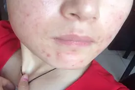 女人脸上长痘痘？小心！这是你肝脏病变发出的信号视频封面