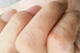 手指上长满颗粒状的小水泡，治疗湿疹的常规药物基本无效，怎么治视频封面