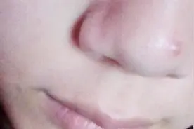 鼻子出现水泡怎么办？这是单纯疱疹，一定要按照这个办法处理！视频封面