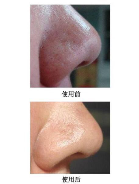 如何去黑头收缩毛孔最实用的小妙招！最管用