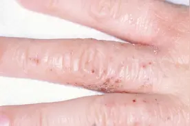 人为性皮炎如何治疗！皮肤专家有妙招！