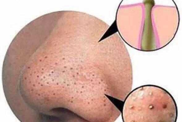 如何去黑头收缩毛孔最实用的小妙招！最管用