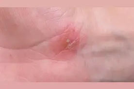 手上起小水泡痒是怎么回事？怎么办呢？