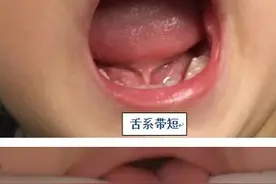 家长快来对照：孩子的舌系带短吗？需要手术吗？#葉子口腔科普#图片