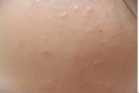 脸上不痛不痒的小疙瘩  闭口粉刺到底是什么鬼？图片