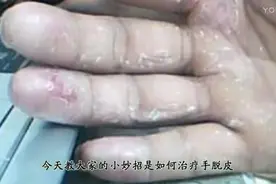 手脱皮不用怕，自己去买瓶维生素C注射液，轻松搞定视频封面