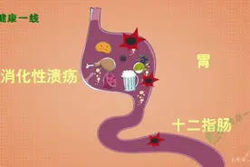 一分钟告诉你胃穿孔到底是怎么回事？视频封面