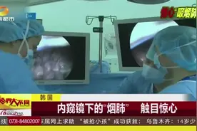 韩国 内窥镜下的“烟肺” 触目惊心视频封面
