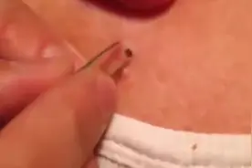 各种大黑头被挤爆的过程，看完莫名的舒畅，有点想挤的冲动！图片