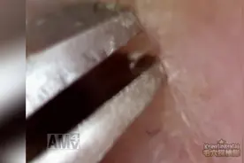 近镜头下拔黑头，一个接着一个，拔的好爽，有上去帮着拔的冲动图片