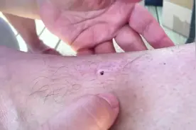 挤掉腿上的大黑头，本以为挤两下就没了，结果源源不断挤这么半天图片