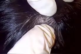 男子头皮患上毛囊炎，医生费了番功夫才帮他挤出清理干净视频封面