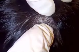 男子头皮患上毛囊炎，医生费了番功夫才帮他挤出清理干净视频封面