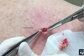 她肩头长了囊肿型疙瘩，通过医生挤出清除后，感觉好很多视频封面