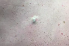 一颗优质大黑头差点毁在了这个人手里，看到正确的取出后好舒畅！图片