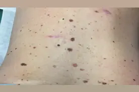 医生清除后背的黑头，这俩黑头竟然这么费劲！好想去帮忙！图片