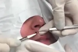 5个大黑头被挤出的过程，挤完瞬间舒了口气，看着好舒服！图片