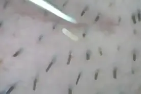下巴粉刺一直长惨不忍睹！医生这样快狠准清除，终于和它说拜拜了图片