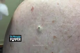 一颗优质超大黑头被挤爆，感觉挤的好干净很专业，看的好爽！图片