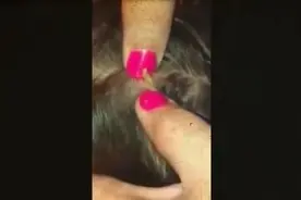 妈妈帮小女孩挤掉头顶的大黑头！黑头怎么会在这个位置？图片