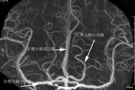 微血管减压术治疗面肌痉挛图片