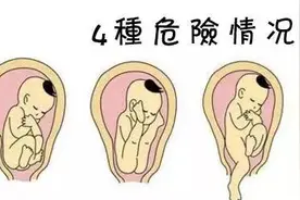 高清动图详解胎儿臀位生产全过程！胎儿臀位想顺产的先看看吧！图片