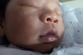 疾病百科丨口唇发紫是先天性心脏病患儿最常见的表现图片