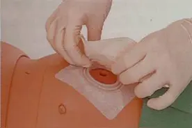 肛门里塞进一个球，让他的肚子上挂了粪袋图片