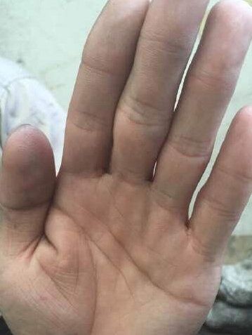 "凤眼纹"在拇指第一节的地方,女人手相上出现貌如眼睛的"凤眼纹"是