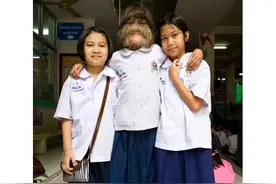 罕见 脸上长满毛发的泰国女狼孩图片