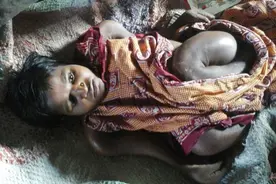 印度女子患罕见病 身高缩短只剩60cm图片