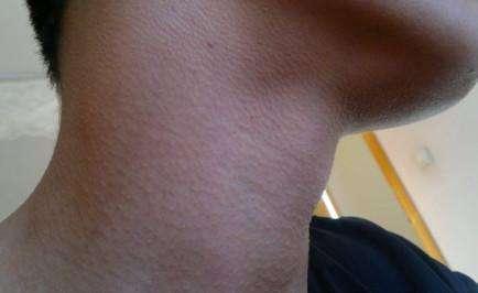 怎样可以去鸡皮疙瘩皮肤