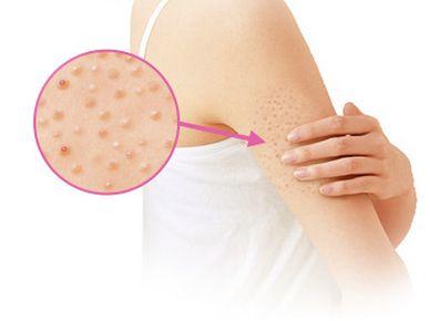 怎样可以去鸡皮疙瘩皮肤