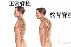 北京医院骨科成功使驼背患者挺直了腰！图片